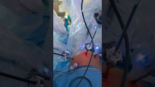 How robotic surgery works