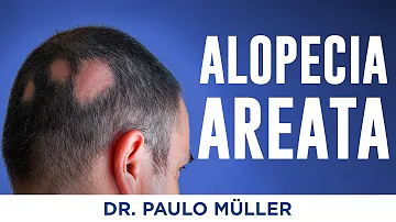 Como curei minha alopécia areata?