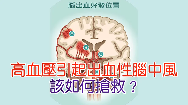 高血压引起出血性脑中风 该如何抢救？ - 天天要闻