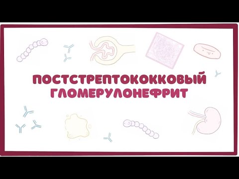 Постстрептококковый гломерулонефрит - причины, симптомы, осложнения (лекция) Osmosis