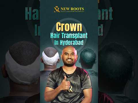 Bald Spot Covered! Crown Hair Transplant Surgery in Hyderabad | New Roots #hairtransplant #shorts