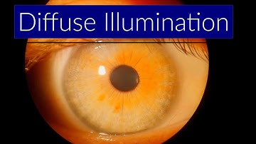 Diffuse Illumination - Slit Lamp Techniques