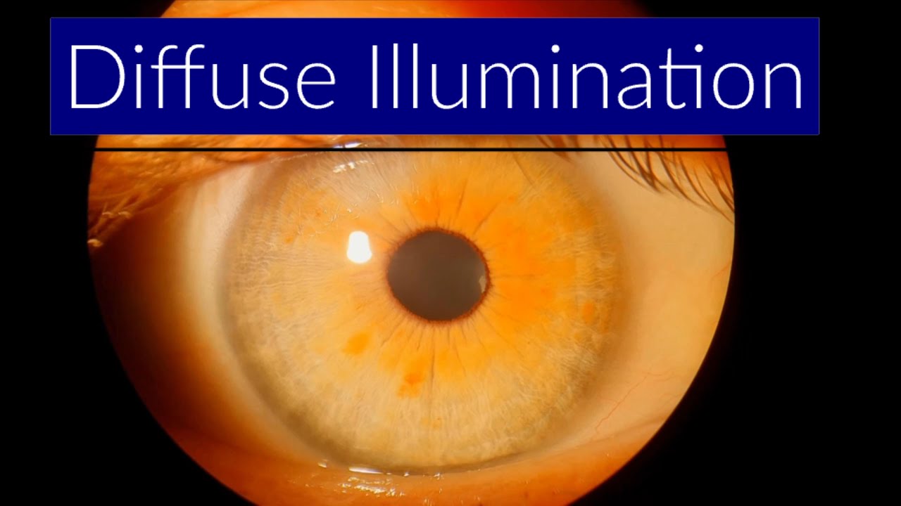 Diffuse Illumination Slit Lamp Techniques YouTube