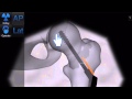 Bonedoc - Placing the plate