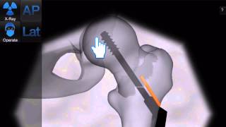 Bonedoc - Placing the plate