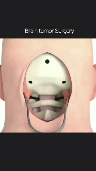Brain Tumor Removal 👍 An overview how to remove brain tumor surgery ✅