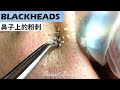 鼻子上的粉刺(blackheads) - Taiwan Tainan台南清粉刺最乾淨