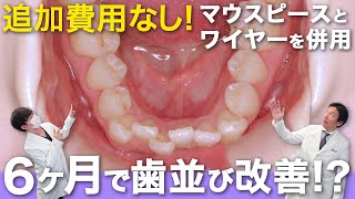 症例紹介！〜凸凹・倒れ込みを治したい！〜【渋谷矯正歯科・キュア矯正歯科グループ】【歯列矯正】