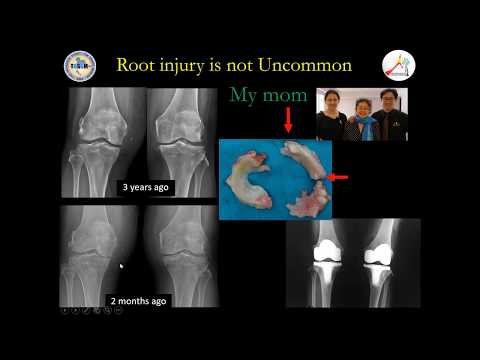 ACL and meniscus root tear เอ็นไขว้หน้าหมอนรองกระดูกขาด BanchaC บัญชา ชื่นชูจิตต์ TU thailand