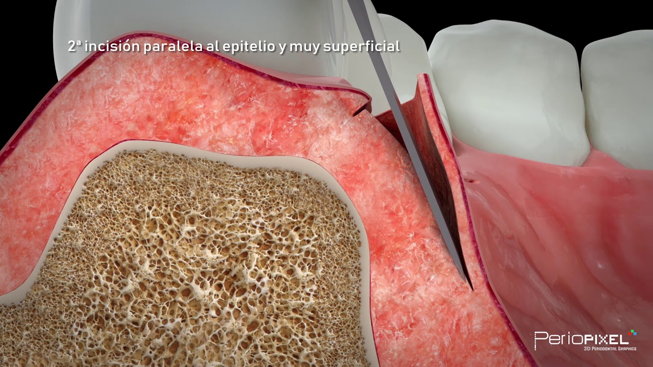 Implante simultáneo post extracción con preservación de volumen total