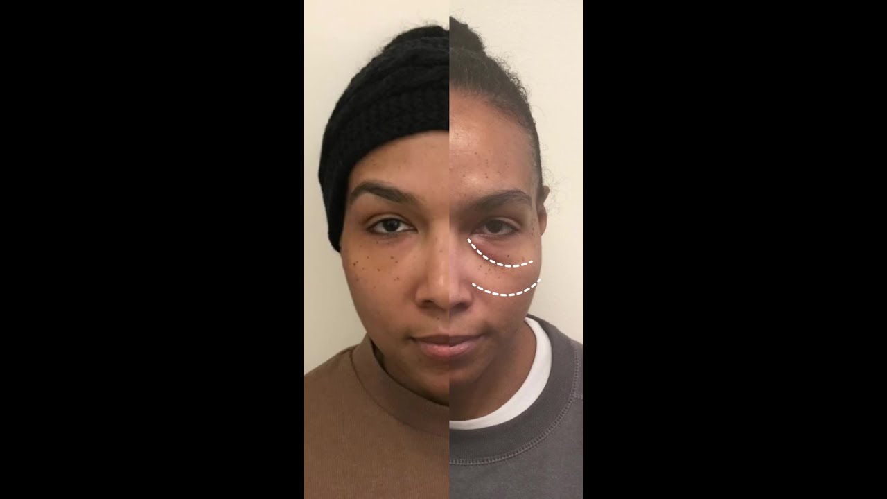 Non-Surgical Eyebag Solution | EyeRise at VERVE Medical Cosmetics