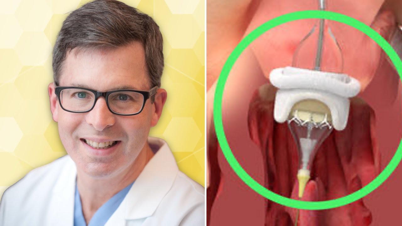 Вопросы и ответы хирургов: транскатетерные операции по замене митрального клапана на клапан