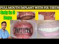 Live full mouth dental implant procedure completed within 5 days only