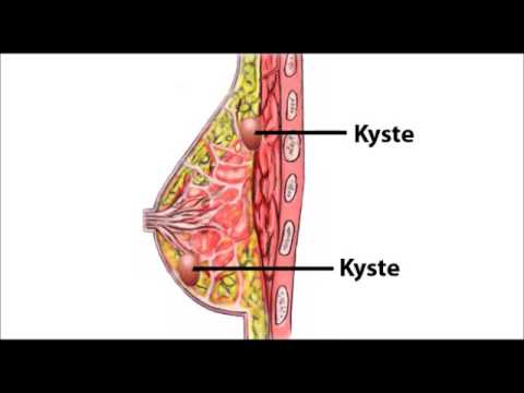 Vidéo: Kyste Mammaire: Symptômes, Traitement, Causes