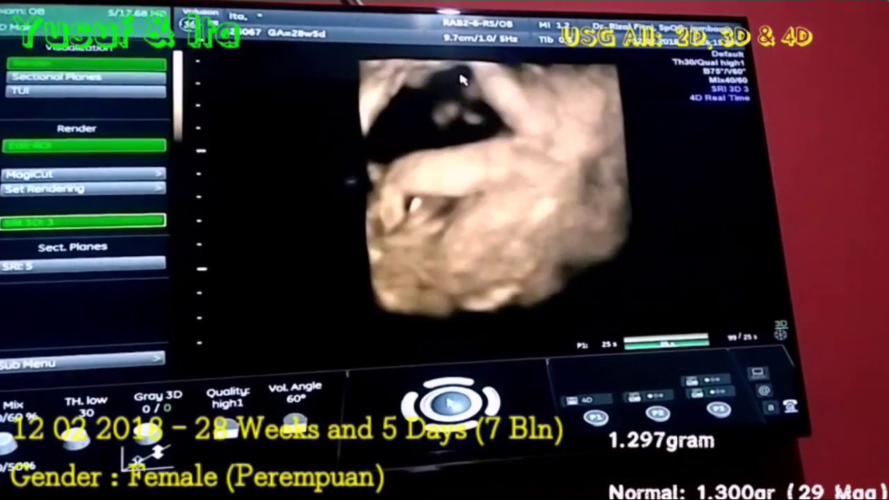 Hasil USG 4 Dimensi Janin/Bayi Usia 28 Minggu (7 Bulan) USG Mode 2D