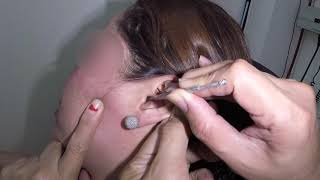 Check out my facebook page for more videos & updates
https://www.facebook.com/earwaxspecialist/ear pocket otoscope:
https://amzn.to/2hrinp7 digital ear camer...