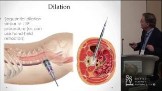 Oblique Lumbar Interbody Fusion (OLIF) - Kevin T. Foley, MD