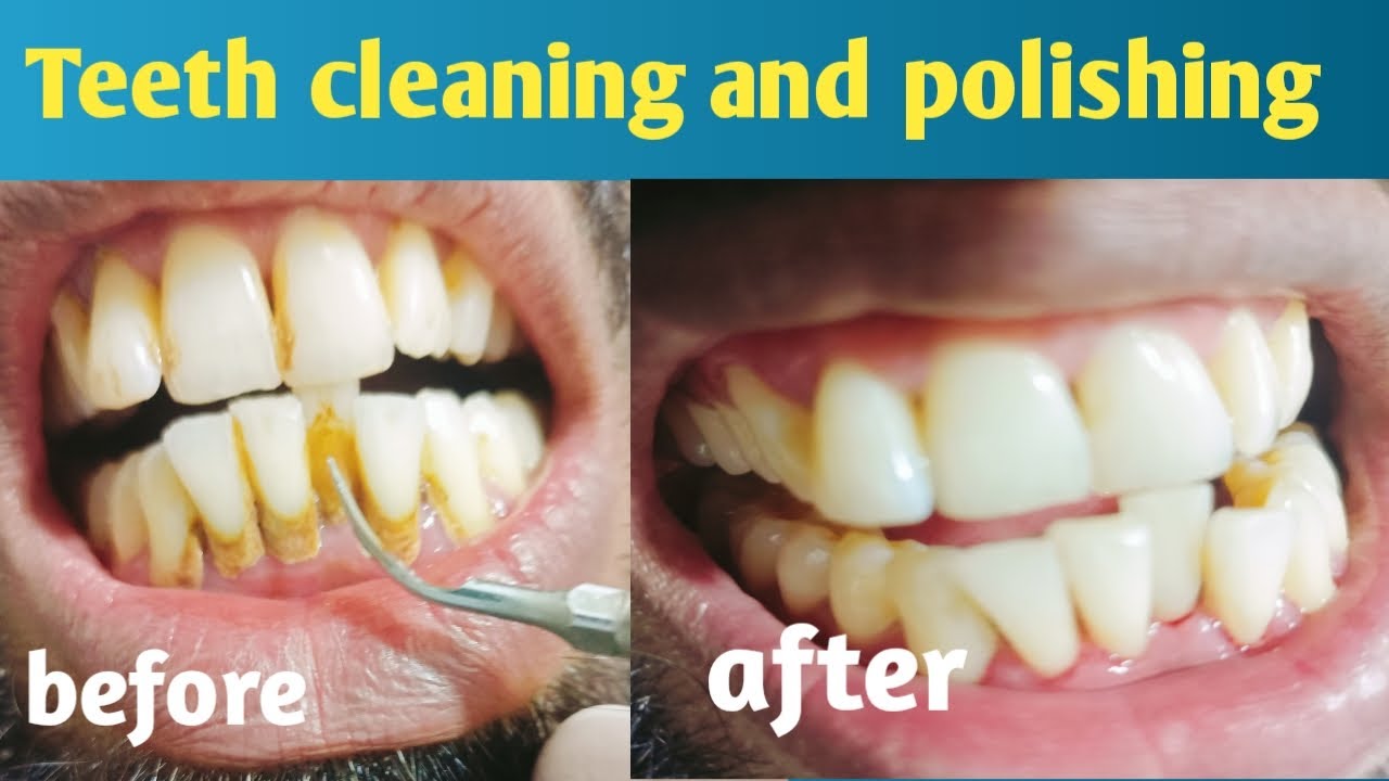 teeth cleaning and polishing YouTube