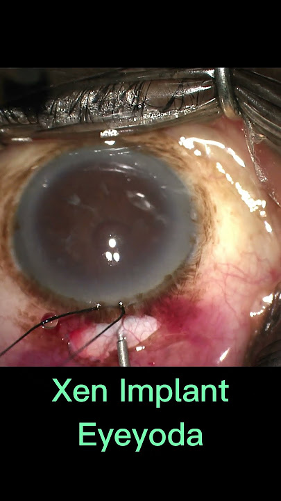 Xen implant! #glaucomasurgery #eyesurgery #ophthalmology #glaucoma #eyes #glaucomatreatment