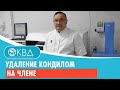 💣 Удаление кондилом на члене. Клинический случай №176