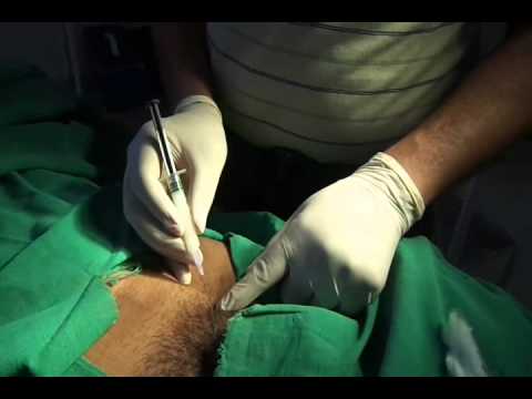 Steroid injection in post operative chronic non specific pain after hernia operation major field of study medicine