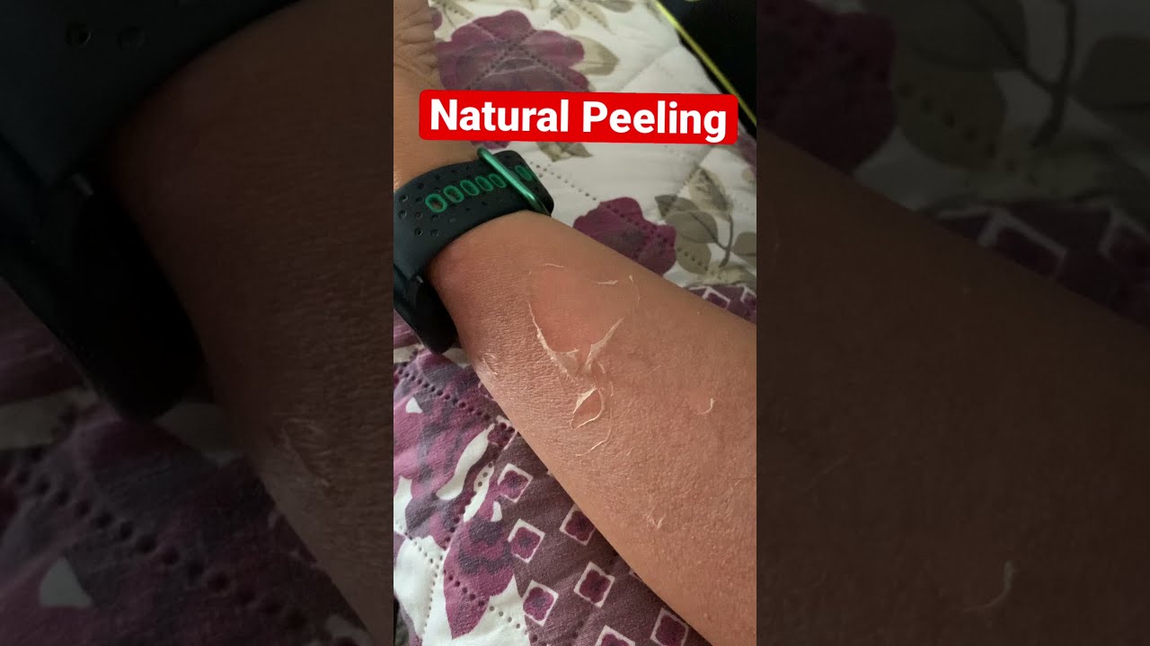 Sunburn Peeling #sunburn #shorts #skinpeeling #sunburnskinpeeling #sunburnpeeling