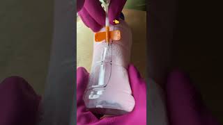 Av Fistula: Needle Cannulation And Clinical Pearls Av Fistula: Needle Cannulation And Clinical Pearls