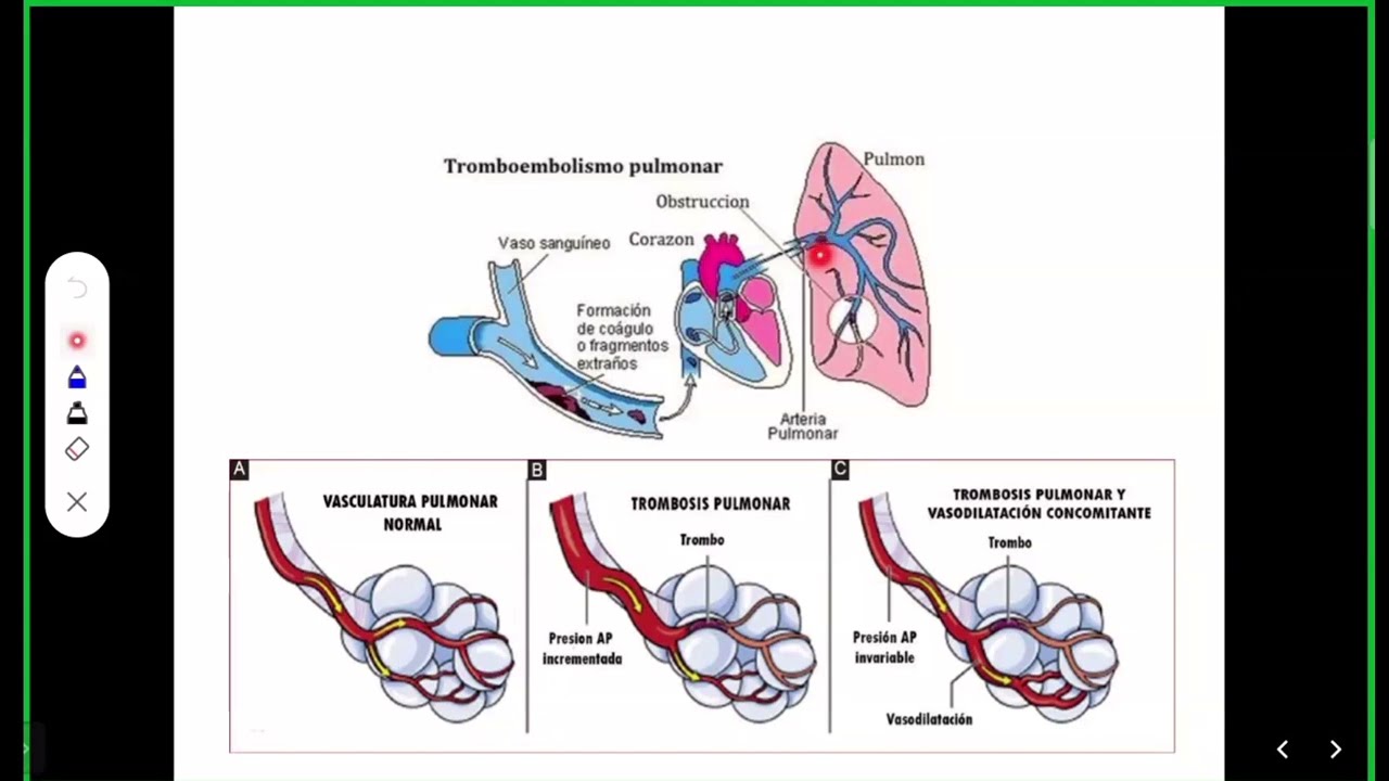 Clase 15 - Embolismo pulmonar