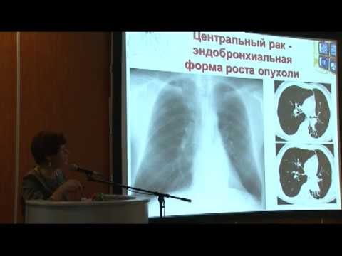 Лучевая диагностика немелкоклеточного рака легкого