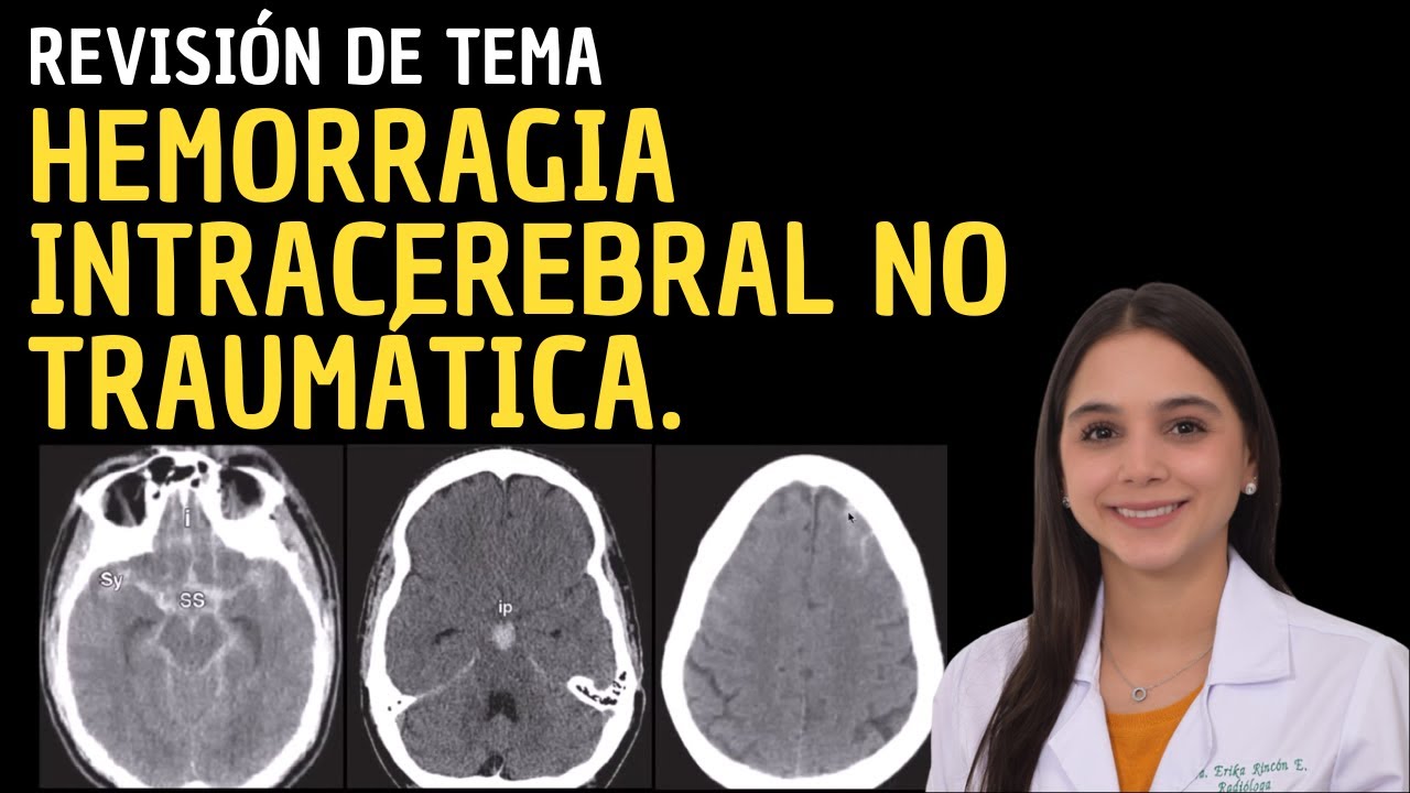 Revisi N De Tema Hemorragia Intracerebral No Traum Tica Youtube