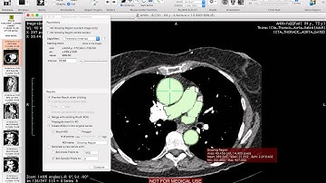 Volume Rendering OsiriX