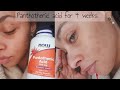 I TRIED PANTOTHENIC ACID FOR 4 WEEKS - BEFORE & AFTERS