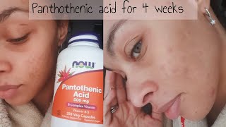 I TRIED PANTOTHENIC ACID FOR 4 WEEKS - BEFORE & AFTERS