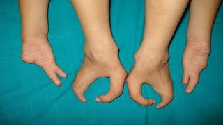Top 10 Most Bizarre Genetic Mutations in Humans - Awesome
