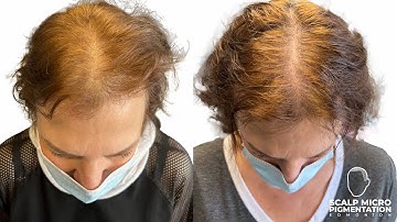 Female thin hair treatment. SMP scalp micro pigmentation