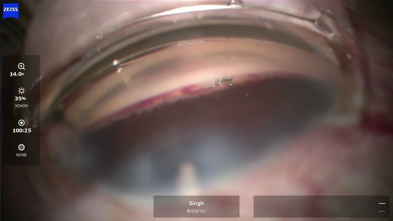 HYDRUS CLOSE UP- I Paul Singh, MD