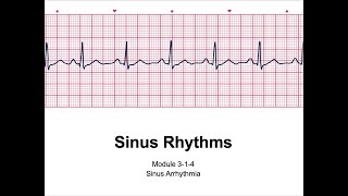 Paramedic Cardiology Module 3-1 Lecture 4:  Sinus Arrhythmia