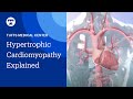 Hypertrophic Cardiomyopathy (HCM) Explained | Tufts Medical Center