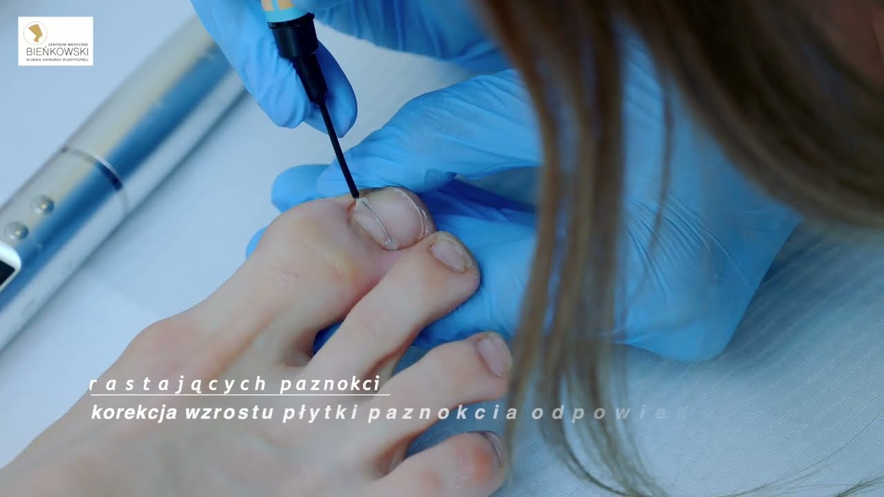 Wrastający paznokieć - www.wbienkowski.pl