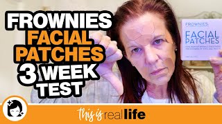 Frownies Facial Patches 3 Week Test - THIS IS REAL LIFE