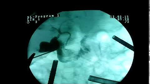 Laparoscopic Cholangiogram
