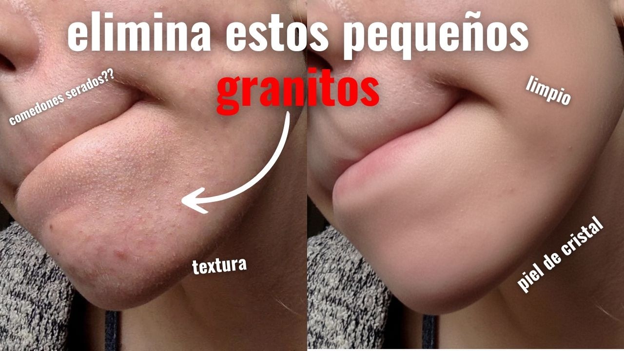 ¿Tienes textura en la piel? Adiós a los granitos que NO revientan ☁️