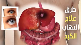 التهاب الكبد: فرصة ربانية لإنعاش أعظم عضوفي جسمك الكبد الدهني - الوقاية من التهاب كبدي