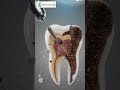 Why Ignoring a Cavity Can Be Life Threatening! 😳 #shorts #dentalhealth #healthtips #satisfying