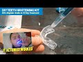 DIY Home Whitening That Actually Works. Amazon Pro Teeth Whitening Kit Review & Instructions.