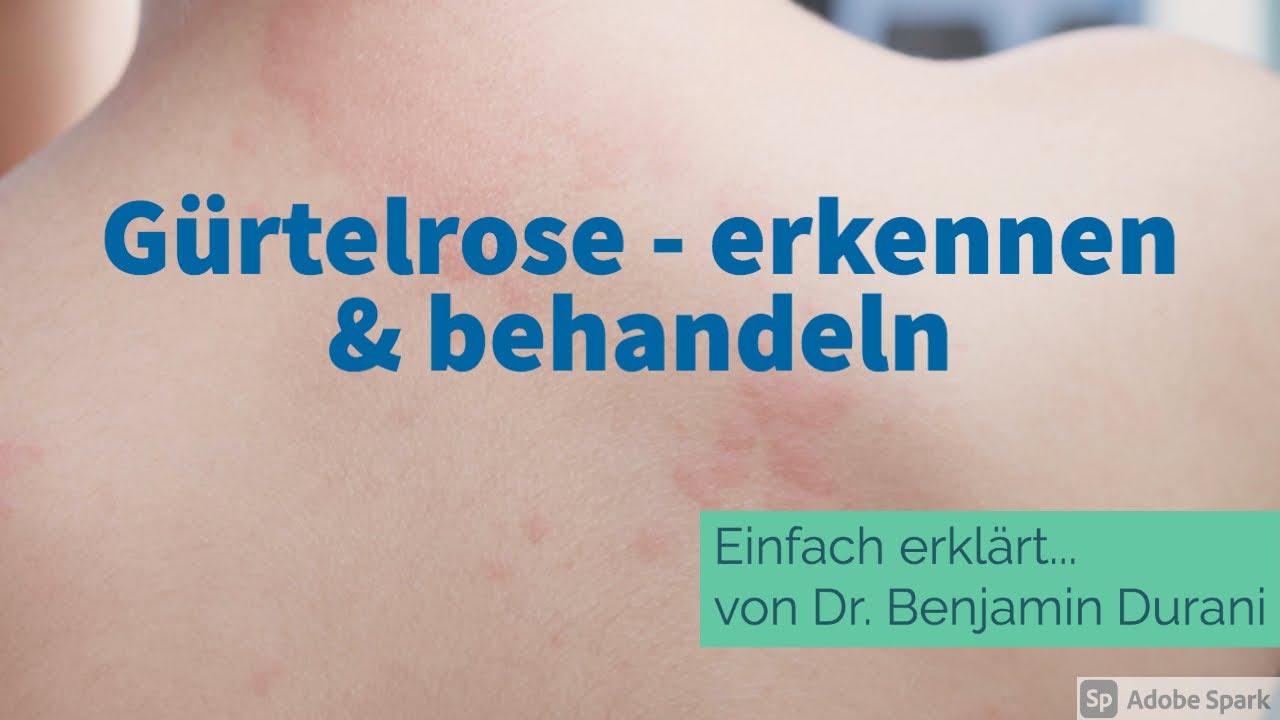 Darf Ich Mit Gürtelrose In Der Pflege Arbeiten Gürtelrose - erkennen & behandeln - Einfach erklärt von Dr. Durani