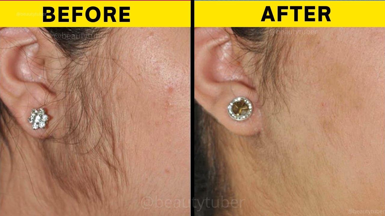No Pain Facial Hair Removal Permanently In 5 Minutes at Home Remove