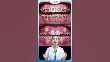 Sự Thay Đổi Sau Niềng Răng Của Hàm Răng Khấp Khểnh | Nha Khoa Minh Châu
