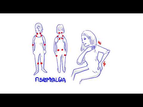 Video: Je To Fibromyalgie? Příčiny Necitlivosti V Nohou A Chodidlech