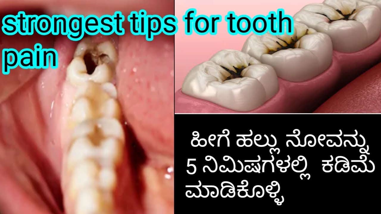 ಹುಳುಕು ಹಲ್ಲಿನ ನೋವಿಗೆ 5 ನಿಮಿಷಗಳಲ್ಲಿ ಪರಿಹಾರ l teeth pain relief remedy